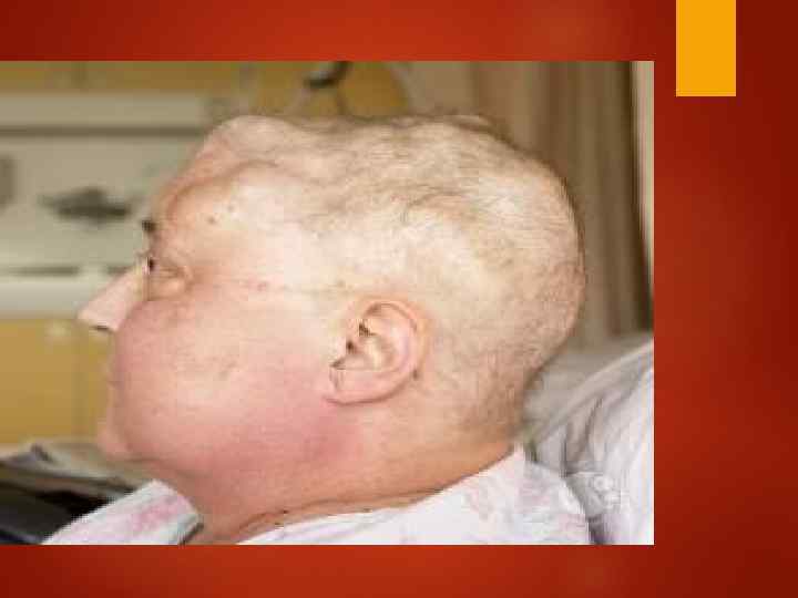 Варианты поражения почек при множественной миеломе 1.  Миеломная почка (цилиндровая нефропатия) 2. Парапротеинемический