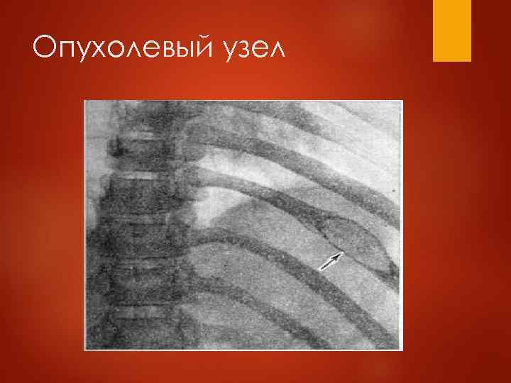 Почечная недостаточность при ММ  По данным двух крупных исследований  43% из 998