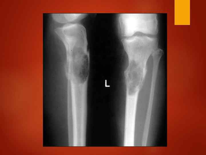 Цилиндровая нефропатия Основу слепков-цилиндров составляют легкие цепи, связывающиеся с белком Тамма-Хорсфалла, он синтезируется клетками