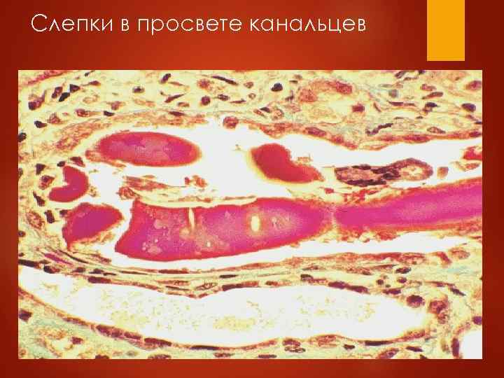  Среди легких цепей иммуноглобулинов наибольшей амилоидогенностью обладает каппа- 6 - тип. Это объясняет