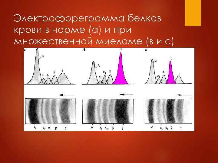   Отличие первичного генерализованного  амилоидоза (ПГА) от AL амилоидоза при  