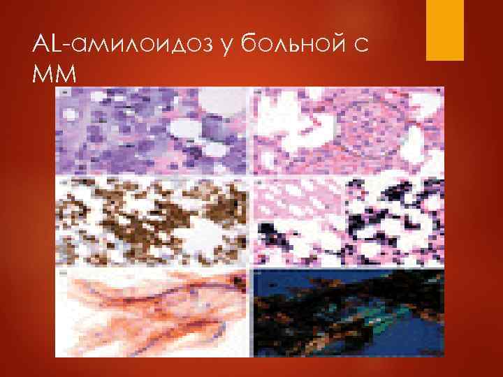 Гломерулонефрит  При. ММ развивается редко, по типу паранеопластического, в связи с образованием ЦИК.