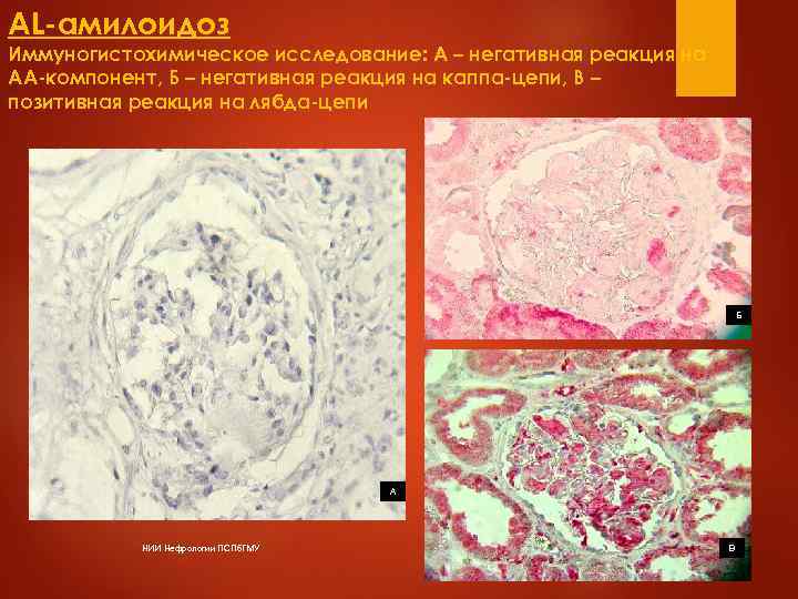 Острая почечная недостаточность  В большинстве случаев обусловлена повышенным осаждением парапротеинов в канальцах. 