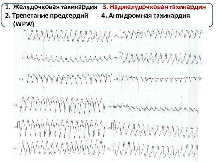 Желудочковая тахикардия карта вызова