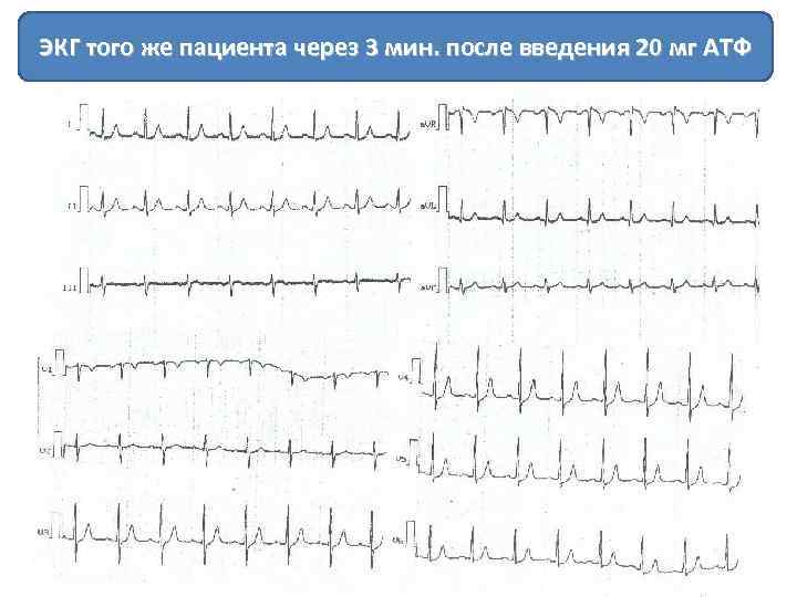 ЭКГ того же пациента через 3 мин. после введения 20 мг АТФ 