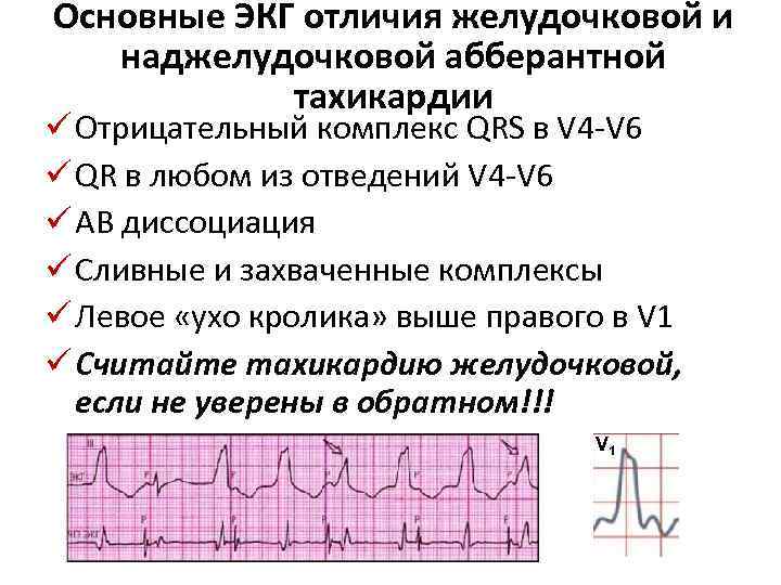 Основные ЭКГ отличия желудочковой и наджелудочковой абберантной тахикардии ü Отрицательный комплекс QRS в V