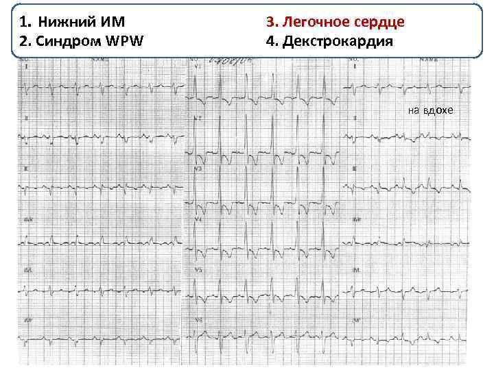 1. Нижний ИМ У пациента 31 лет, находившегося в травматологическом отделении, 3. Легочное сердце