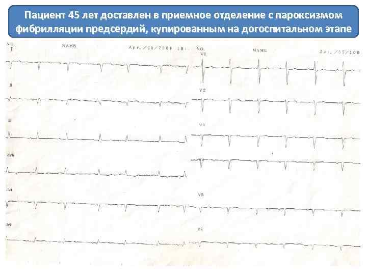  Пациент 45 лет доставлен в приемное отделение с пароксизмом фибрилляции предсердий, купированным на