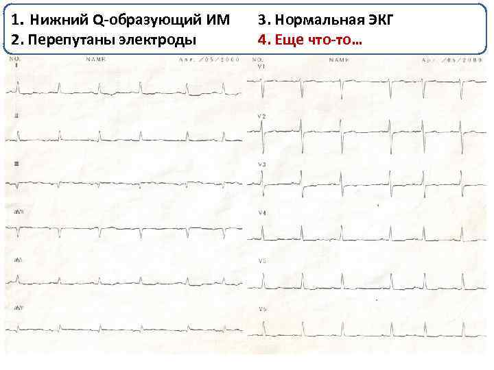 1. Нижний Q-образующий ИМ 3. Нормальная ЭКГ того же пациента, переснятая через несколько минут