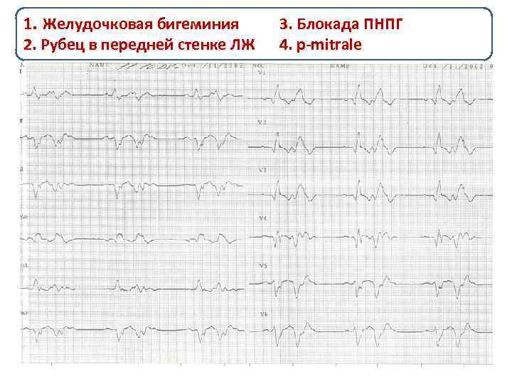 1. Пациентка 76 лет бигеминия Желудочковая госпитализирована. с жалобами на перебои в 3. Блокада