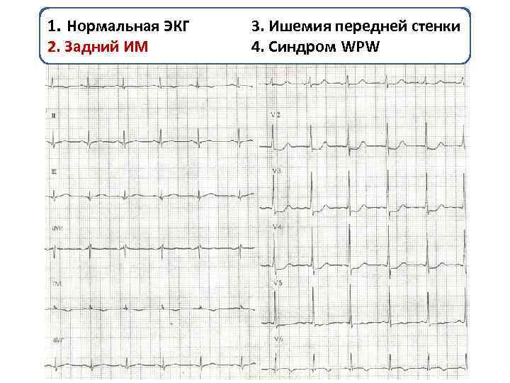 Схема нормальной экг