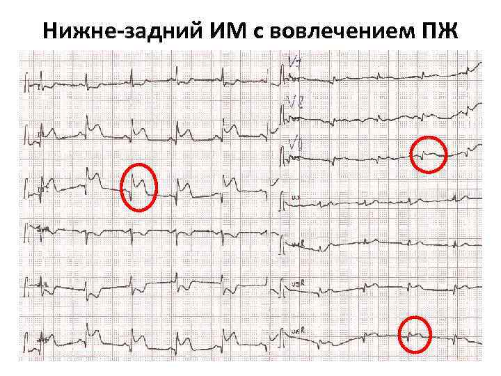 Нижне-задний ИМ с вовлечением ПЖ 