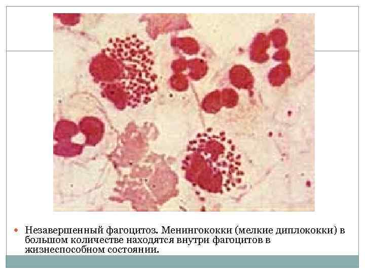  Незавершенный фагоцитоз. Менингококки (мелкие диплококки) в  большом количестве находятся внутри фагоцитов в