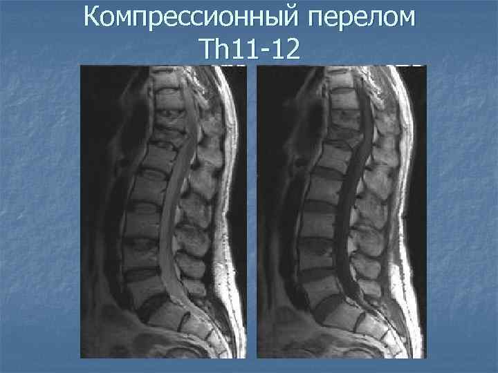 Компрессионный перелом Th 11 -12 