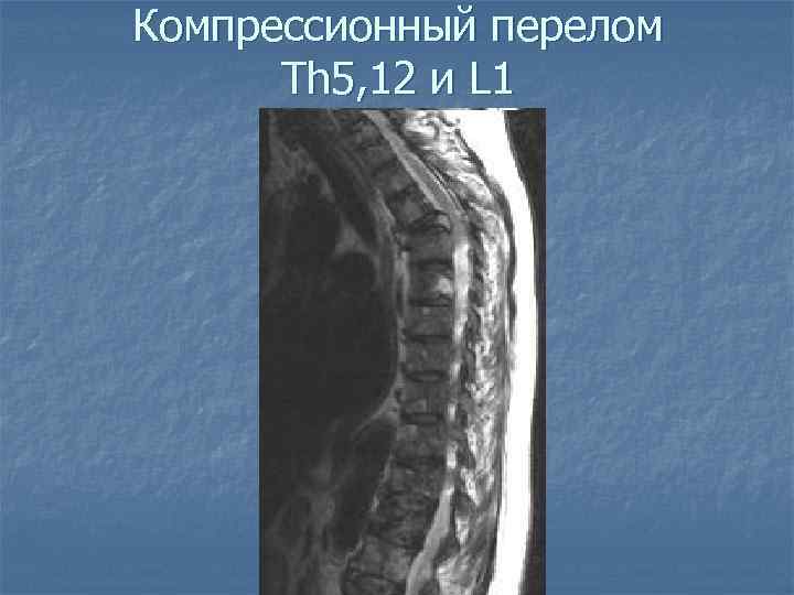 Компрессионный перелом Th 5, 12 и L 1 