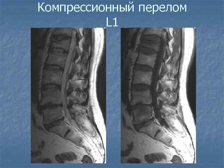 Компрессионный перелом L 1 