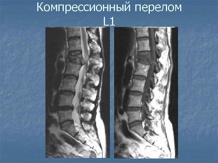 Компрессионный перелом L 1 