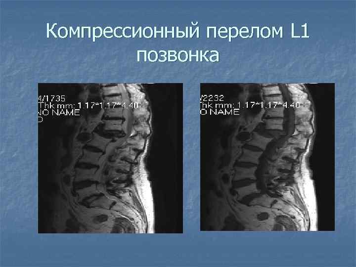 Компрессионный перелом L 1 позвонка 