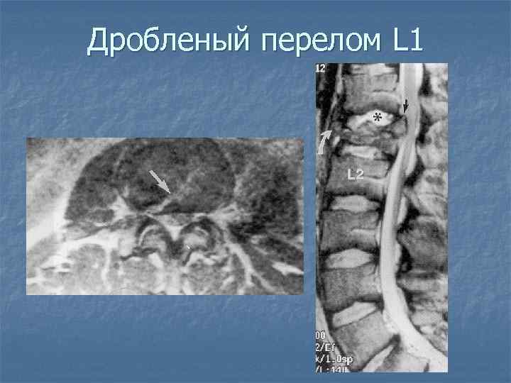 Дробленый перелом L 1 