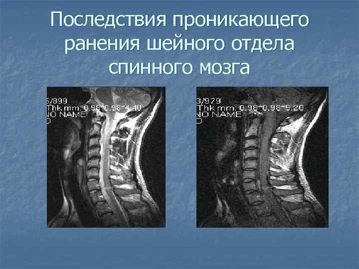 Последствия проникающего ранения шейного отдела спинного мозга 