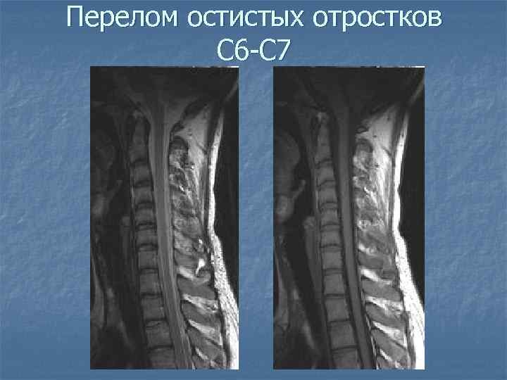 Перелом остистых отростков С 6 -С 7 