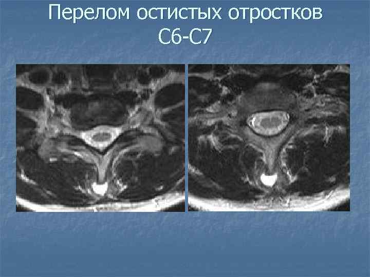 Перелом остистых отростков С 6 -С 7 