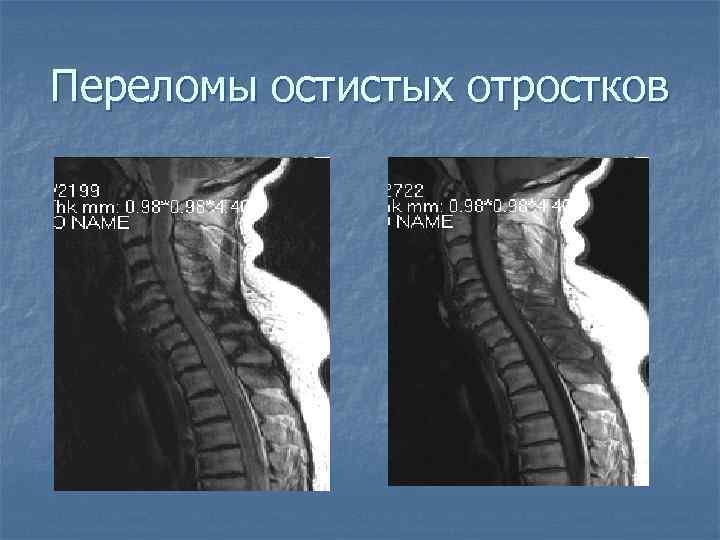 Переломы остистых отростков 