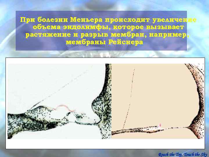 При болезни Меньера происходит увеличение  объема эндолимфы, которое вызывает растяжение и разрыв мембран,