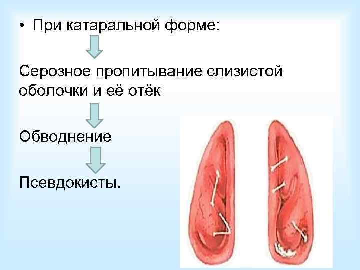  • При гнойной форме:  Клеточная инфильтрация всех слоёв слизистой оболочки лейкоцитами. 