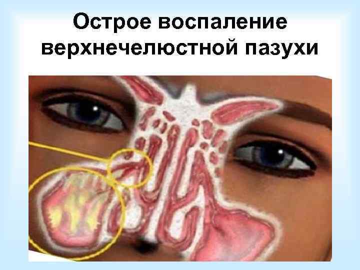  • Основной возбудитель –  Streptococcus pneumoniae • Гемофильная палочка • Pseudomonas aeruginosa.