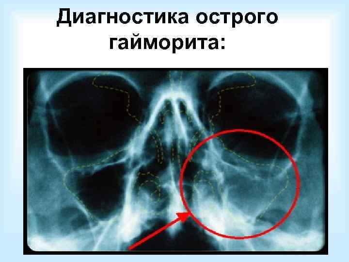  Схема обследования:  • Оценка жалоб, данных анамнеза;  • Общеклиническое и оториноларингологическое