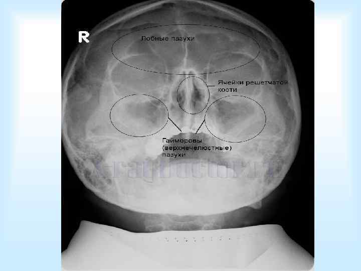  Осложнения пункции:  • Небольшое  кровотечение • Абсцедирование • Воздушная эмболия 