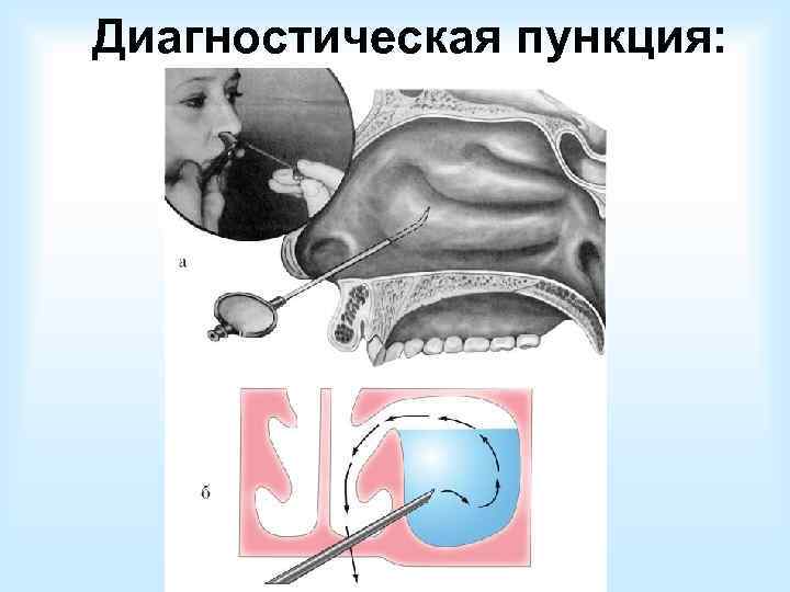  Лечение острого гайморита: Местное: - Сосудосуживающие препараты: 0, 1% р-р эпинефрина, ксилометазолин, нафазолин,