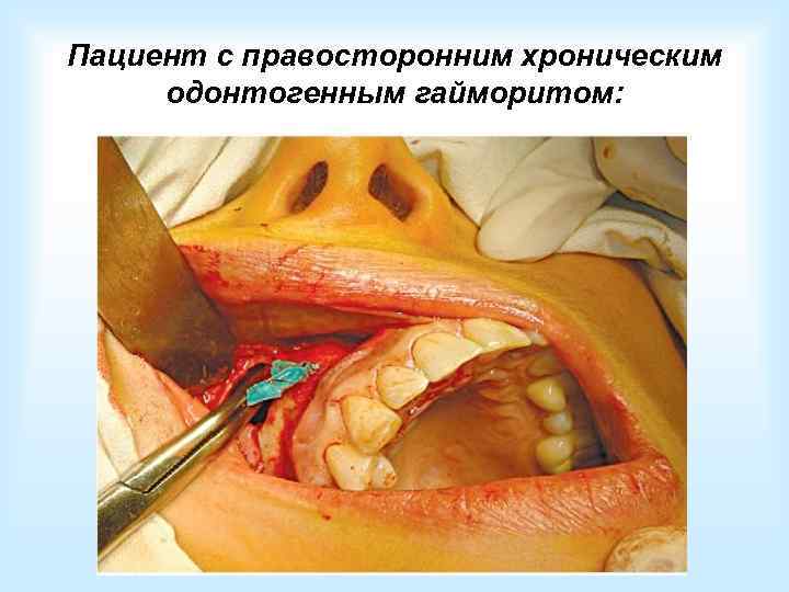    При двусторонних   процессах:  •  Обоняние понижается (гипосмия)