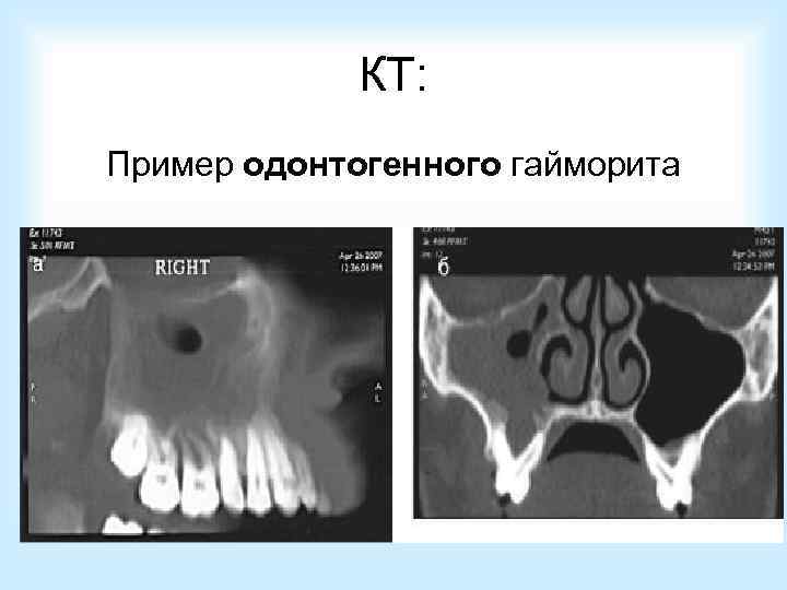  Лечение хронического   гайморита: При катаральной, серозной, экссудативной, гнойной и вазомоторной