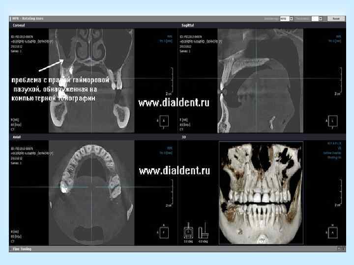 Операция по методу Колдуэлла- Люка: больной лежит на спине.  • 1) В преддверии