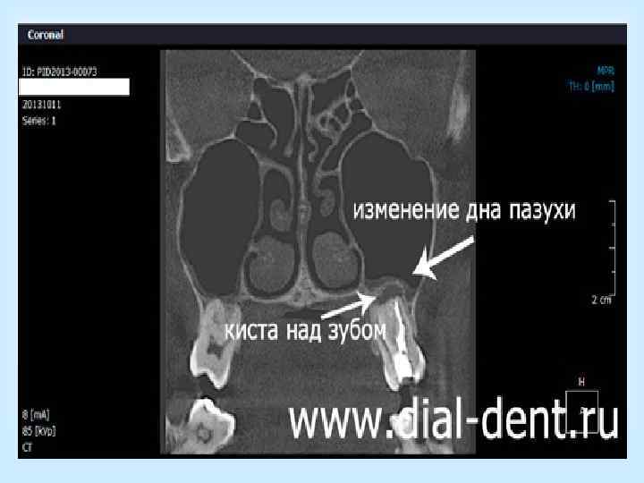  • 3) Операция заканчивается наложением  соустья (контрапертуры) с полостью носа в 