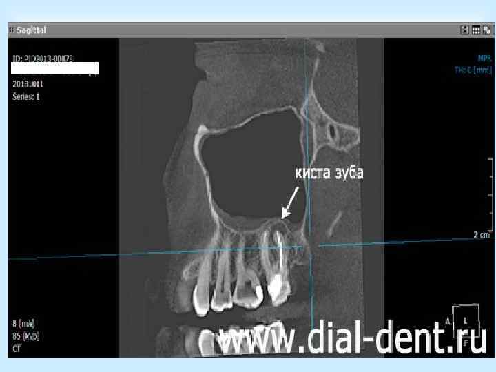 а) разрез под губой; б)трепанация передней стенки верхнечелюстной пазухи; в) ложка, введённая в верхнечелюстную
