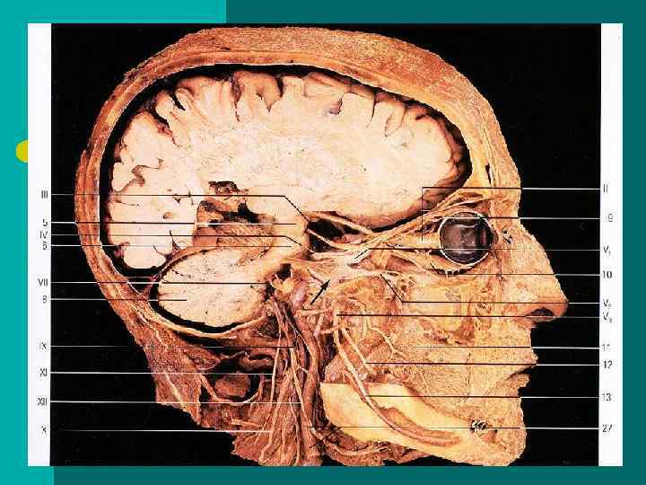I — обонятельные нервы, nn. olfactorii l пред ставлены тонкими стволиками, filamenta olfactoria I — обонятельные нервы, nn. olfactorii l пред ставлены тонкими стволиками, filamenta olfactoria