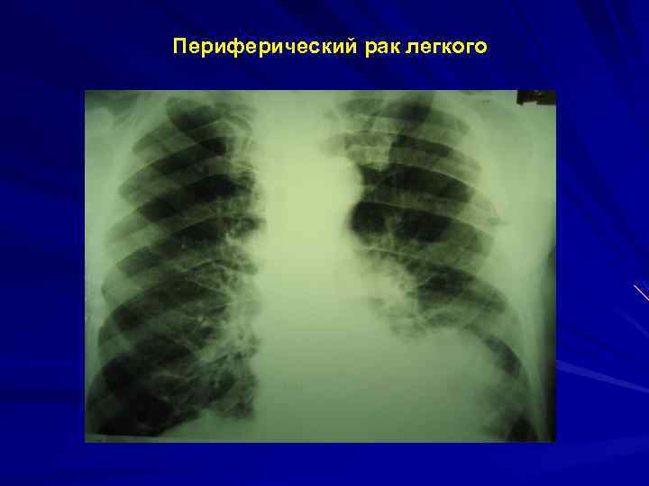 Периферический рак легкого 