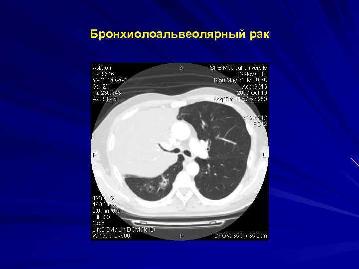 Бронхиолоальвеолярный рак 