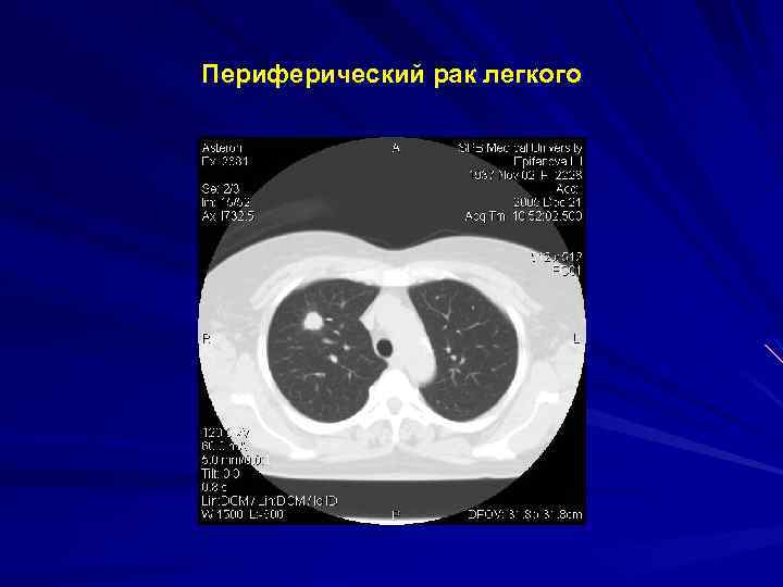 Периферический рак легкого 