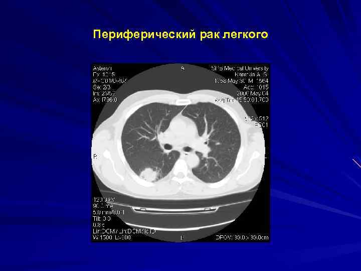 Периферический рак легкого 