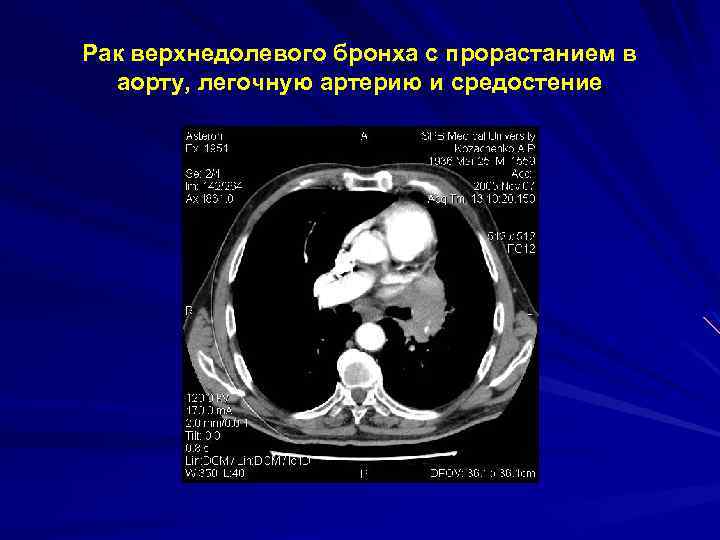 Рак верхнедолевого бронха с прорастанием в аорту, легочную артерию и средостение 