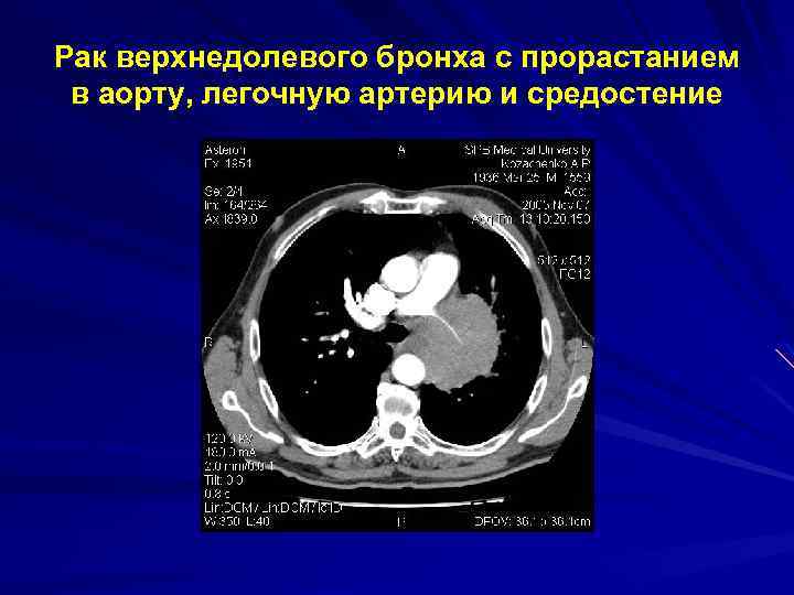 Рак верхнедолевого бронха с прорастанием в аорту, легочную артерию и средостение 