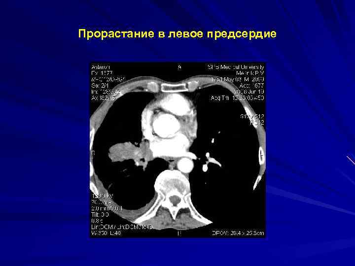 Прорастание в левое предсердие 