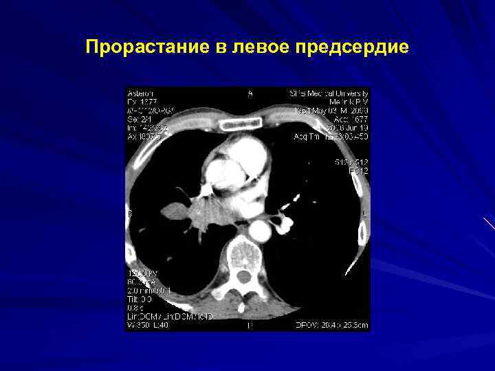 Прорастание в левое предсердие 
