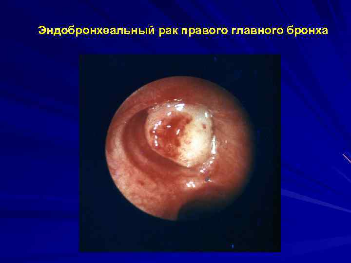 Эндобронхеальный рак правого главного бронха 