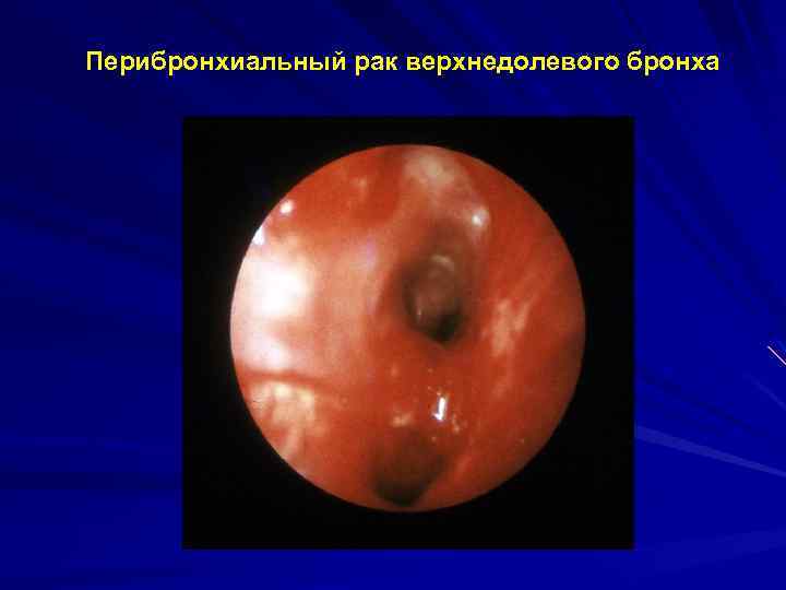 Перибронхиальный рак верхнедолевого бронха 