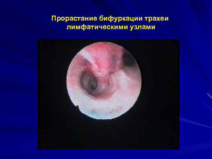 Прорастание бифуркации трахеи лимфатическими узлами 